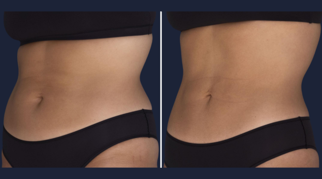 Before and after CoolSculpting Elite